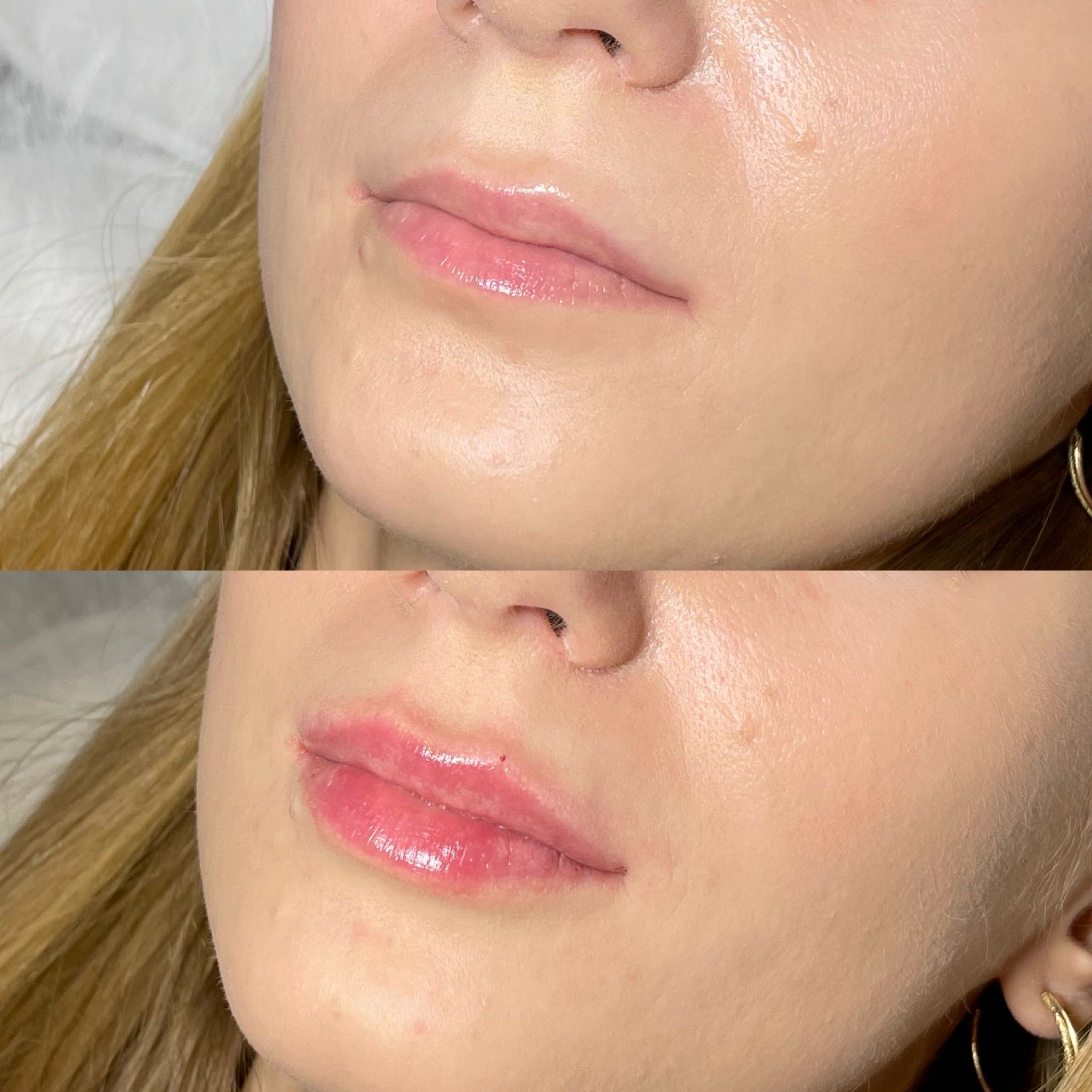 Lip Fillers London: Refined Lip Enhancement & Contemporary Lip Augmentation