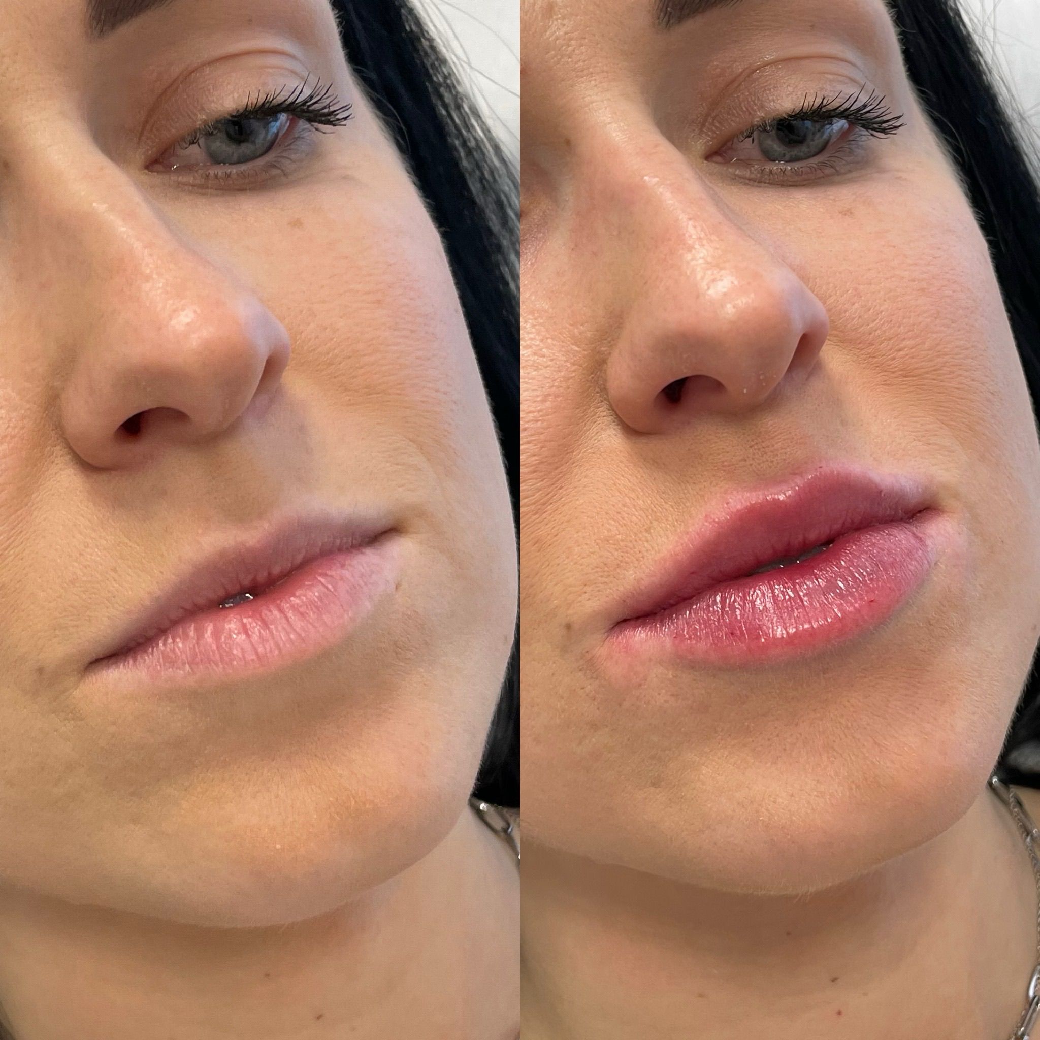Lip Fillers London: Refined Lip Enhancement & Contemporary Lip Augmentation